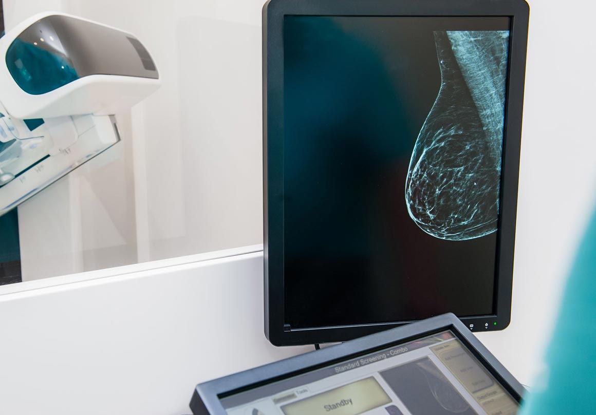 breast cancer risk factors