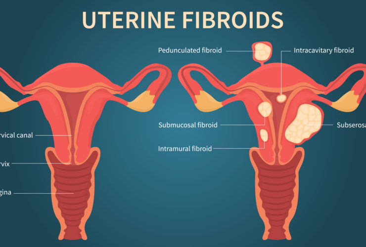 Fibroids
