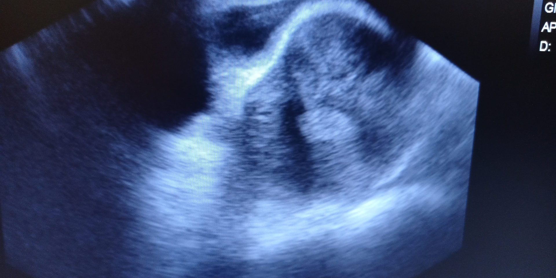 Fibroids